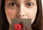 கரும்புள்ளிகள் (Dark spots) போகனுமா? அப்போ இதுதான் சிறந்தது..!